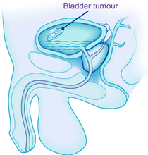 Bladder Cancer Bladder Cancer